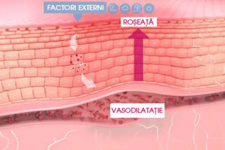 structura pielii cu roșeață