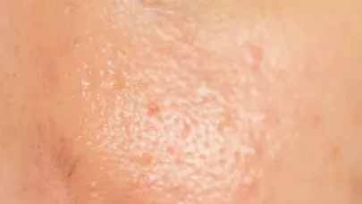 De ce apare acneea? Hiperseboreea și modificările în compoziția lipidică a pielii
