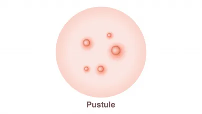 Pustule leziuni inflamate